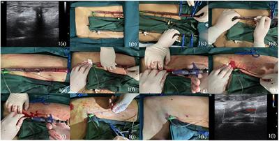 Case report: Total percutaneous post-closure of femoral arterial access sites after veno-arterial extracorporeal membrane oxygenation